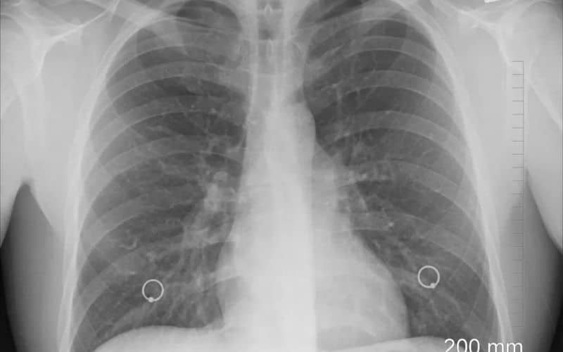 Lung damage diagnosis